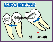 インプラントは水野歯科クリニック　従来の矯正方法